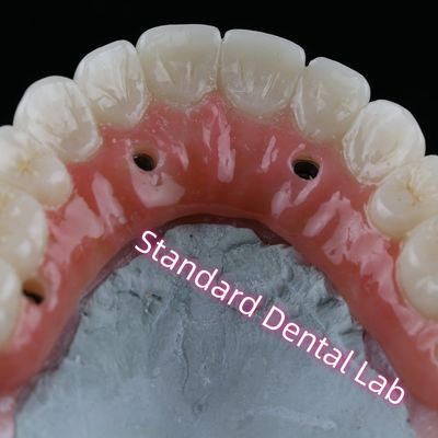 Buy Dental Implant Crown PFZ Porcelain Layered Zirconia Screw Retained With Pink Gum online manufacture