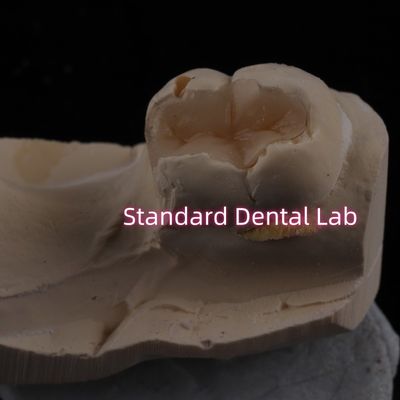 Buy Cast Porcelain Dental Inlay Onlay Overlay Zirconia Emax High Esthetics online manufacture