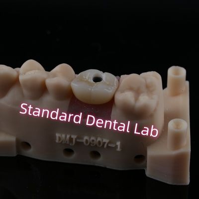 Buy Custom Abutment Implant Crown Full Contour Zirconia Screw Retained online manufacture
