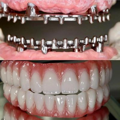 Buy Dental Hybird Malo Implant Bridge Professional Perfect Fit FDA Certified online manufacture