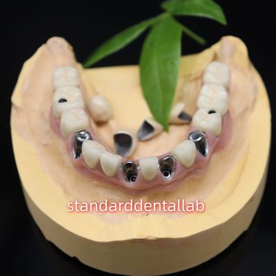 Buy Screw Retained Dental Implant Metal Ceramic Crowns Malo Bridge online manufacture