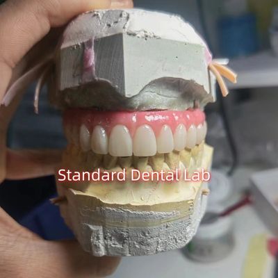 Buy Screw Retained Titanium PMMA Dental Bridge Temporary Crown online manufacture