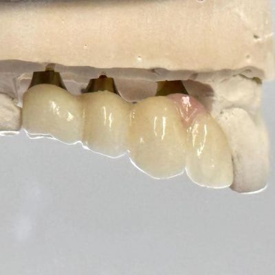 Buy Porcelain Zirconia Cement Retained Screw Implant Hexagonal Head Shape for Custom Fit Esthetics online manufacture