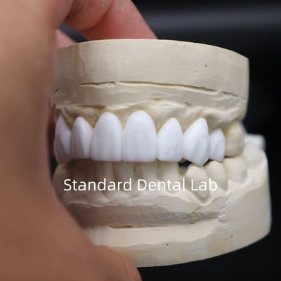 Buy Dental crowns diagnostic wax-up High Esthetics From China Dental Lab online manufacture