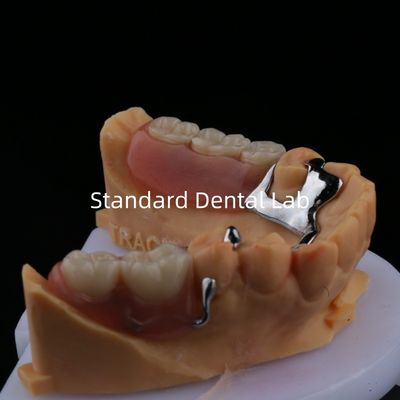 Buy Alloy Metal Partial Denture Framework 3 Shape Exocad Laser Printing Lower Cast Partial Finish online manufacture