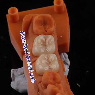 Buy Full Contour Zirconia Crown Translucency 3D PRO No Porcelian Overlay Standard Dental Lab online manufacture
