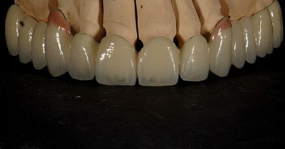 Buy Good Fitting Good Esthetics Multi Layered Zirconia Crown Porcelain Zirconia Bridge online manufacture