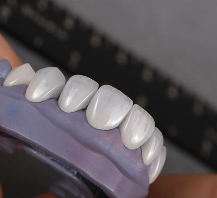 Buy Natural looking Emax Veneers Crown Biocompatibility Bleaching Shade with Minimal Preparation online manufacture