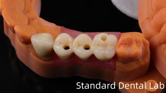 Buy Professional Zirconia Dental Implant Crown Titanium CAD CAM Zirconia Crown China Dental Lab online manufacture