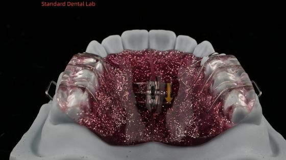 Buy Teeth Expansion And Distalization Adjusting Expander In Mouth Orthodontist Palate Expander online manufacture