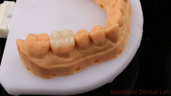 Buy Translucency Zirconia Dental Inlay Onlay Crown For Restore Natural Cavity Shape / Standard Dental Lab online manufacture