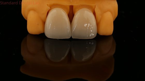 Buy 5 Year Guarantee Full Contour Zirconia Crown Customized Vita Shade High Aesthetic Natural Dental Bridge online manufacture
