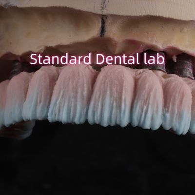 Zirconia Implant Bridge Screw Retained With Pink Gum Porcelain