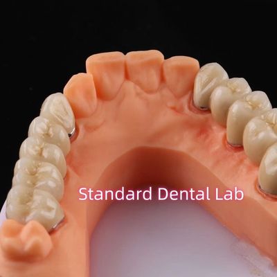 Digital Non Precious Metal Porcelain Crown PFM Bridge Dental