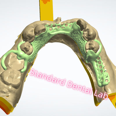 Metal Framework Design Laser Printing Cast Chrome Partial Denture Ni Be Free