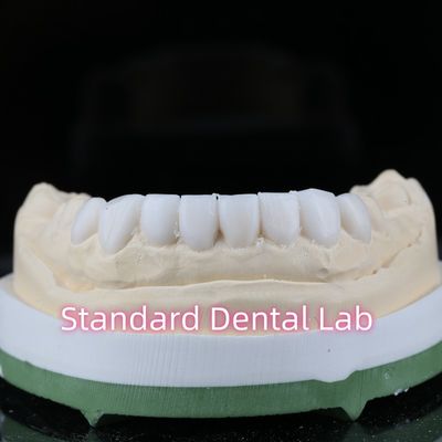 Diagnostic Restorative Dentistry Wax Up Veneers High Esthetics