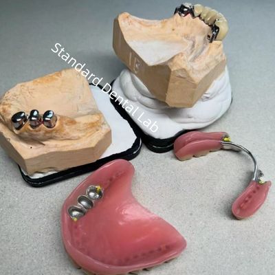 High Esthetics CAD CAM Tooth Partial Denture Attachment Replacement Standard Dental Lab