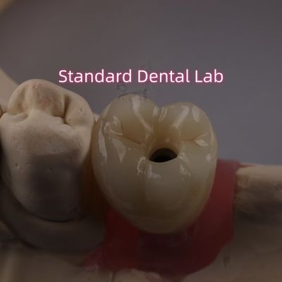 Screw Retained Dental Implant Crown PFZ Porcelain Layered Zirconia