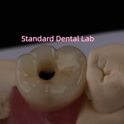 Posterior Implant Crown Bruxier Solid Zirconia Screw Retained