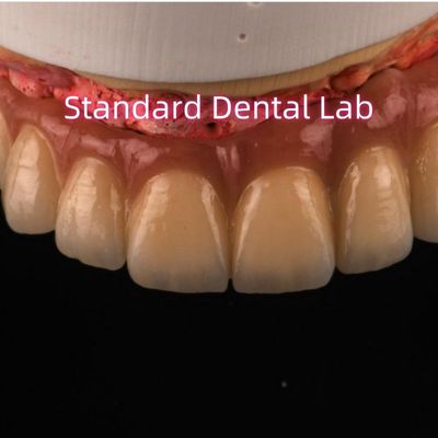PFM Digital Non Precious Metal Porcelain Crowns Bridge High Esthetic Natural