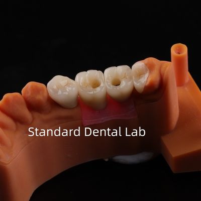 Porcelain Zirconia Dental Implant Bridge Professional High Esthetics