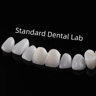 High Esthetic Teeth Emax Laminate Veneers Incisal Translucency