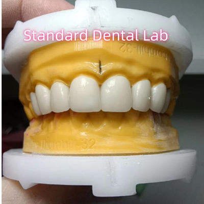 Ivoclar Zirconia Crown Veneers High Translucency Esthetic