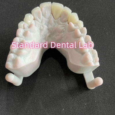 Stars' Smile Dental Teeth Emax Zirconia Laminate Veneers 0.6mm