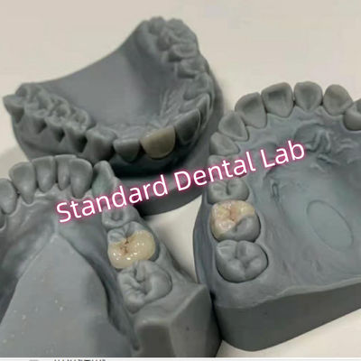 Cosmetic Natural Looking Porcelain Inlays And Onlays Overlays