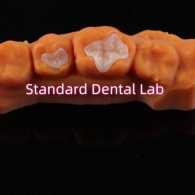 Dental Porcelain Inlay Onlay Overlay Zirconia Emax Composite For Decay Teeth