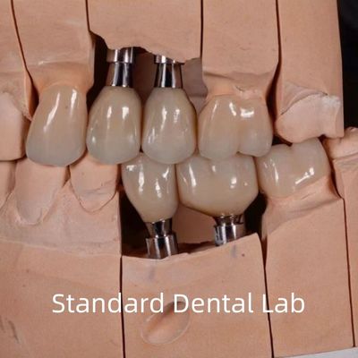 Natural Looking Esthetic Screw Retained Zirconia Implant Crown