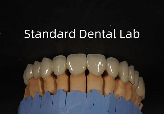 China Dental Lab Metal Ceramic Crown PFM Crown High Esthetics