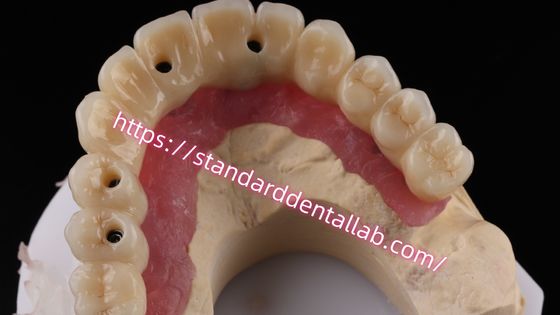 Multi Layer Zirconia Screw Retained Implant Bridge Biocompatible On Metal Structure