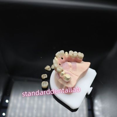 Digital Dental Malo Implant Bridge Titanium Ivoclar Hybrid Zirconia Bridge