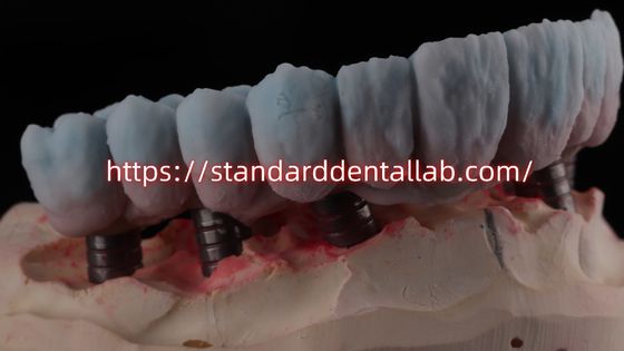 Implant Supported Zirconia Bridge With Titanium Abutment High Esthetics