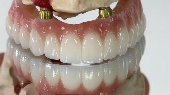 Dental All On X Implant PFM Crown Titanium Fixed Hybrid Denture