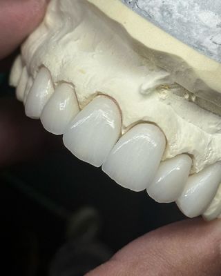 Transluency Layered Zirconia Crown for Optimal Functionality and Natural Aesthetics