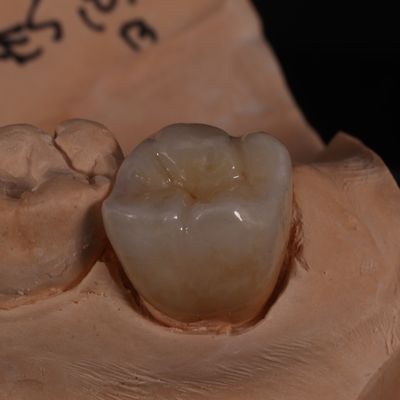 Full Contour Translucent Zirconia Crown for Aesthetically Pleasing Results