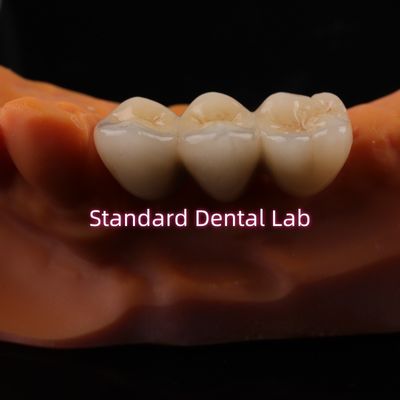 Digital CAD CAM Dental Lab Crowns Translucent Layered Zirconia Crown