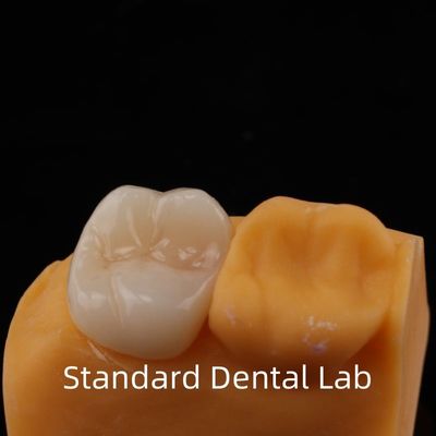 5-Year Guarantee Full Contour Zirconia Crown for Molar Teeth Noritake Porcelain Made in by Trusted Dental Laboratory