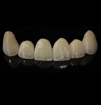 Comfortable Zirconia Crown With Good Fitting And Precision Esthetics