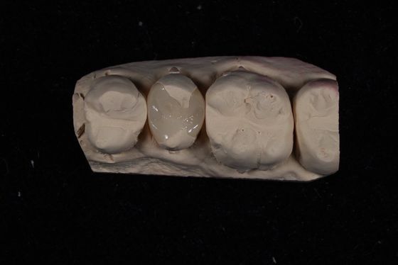 Strength Emax Ceramic Veneers Crown With Excellent Stain Resistance / Biocompatibility