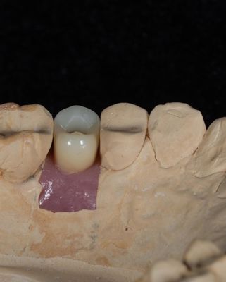Screw Cement Retained Implant For Long-Lasting Dental Implants With 5-Year Guarantee