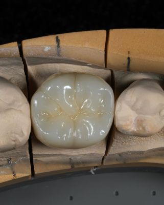 Full Contour Zirconia Crown Quick Turnaround for Precise and Aesthetic Fit in 1 Week