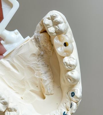 Screw Cement Retained Implant Polished Implants Supported Porcelain Bridge Full Arch