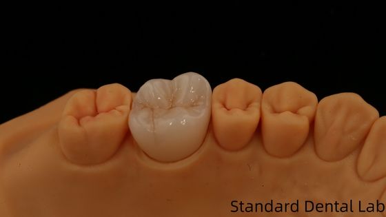 Noritake Porcelain Full Contour Zirconia Crown Customized Vita Shade for Esthetic Digital Dental Restoration by Dental Lab