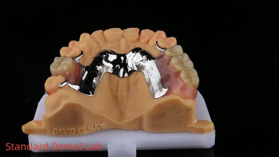 CorCr Metal Partial Denture High Light Beryllium Free Ivoclar Scheftner Comfortable Metal Framewrok