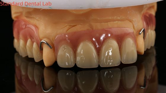 Heat Cured Ivoclar Partial Acrylic Denture Dental Lab High Accuracy with 3D print model