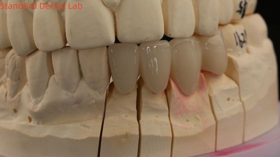 Solid Dental Lab Crowns 3D Pro High Translucency Full Zirconia Crowns with Vita Shade Customized
