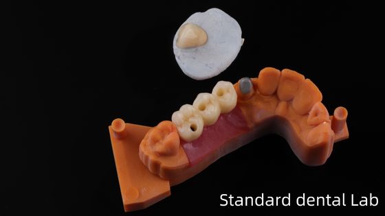 Post Core Dental Lab from China / Metal Post Core with PFM Crown